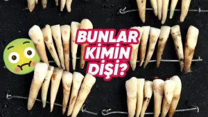 Eski diş hekimliği yöntemleri günümüzdeki standartlarla kıyaslanıyor