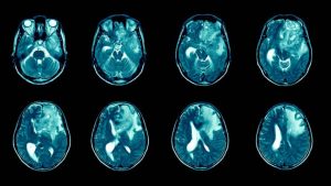 Glioblastoma için yeni tedavi umudu gelişiyor